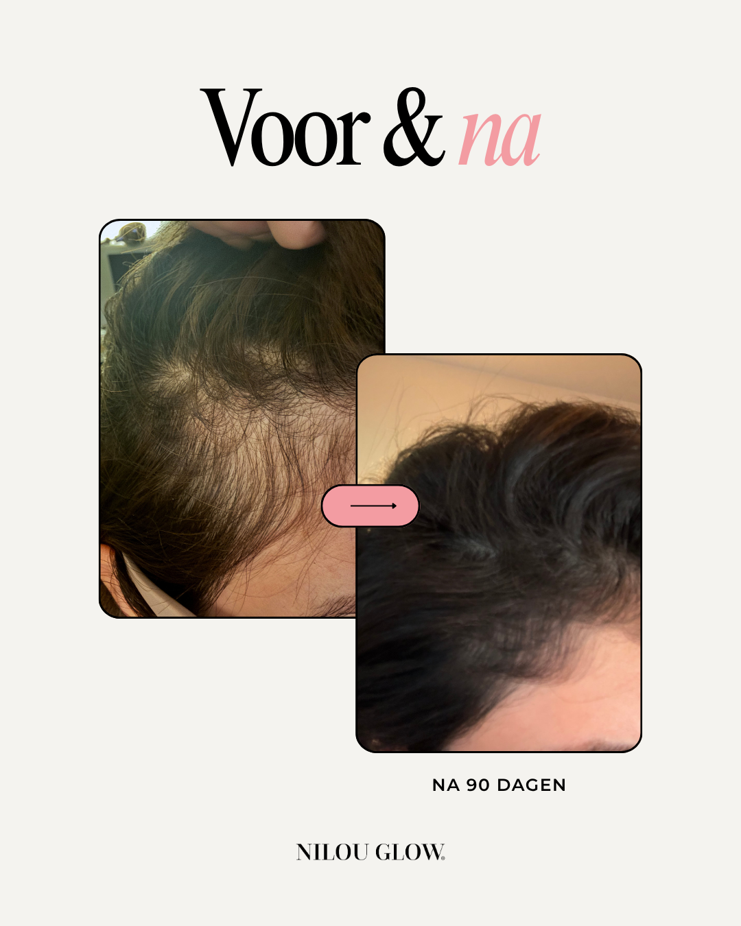 Summer Glow Deal: Hair Gummies (3x) + Free Collagen (1x)
